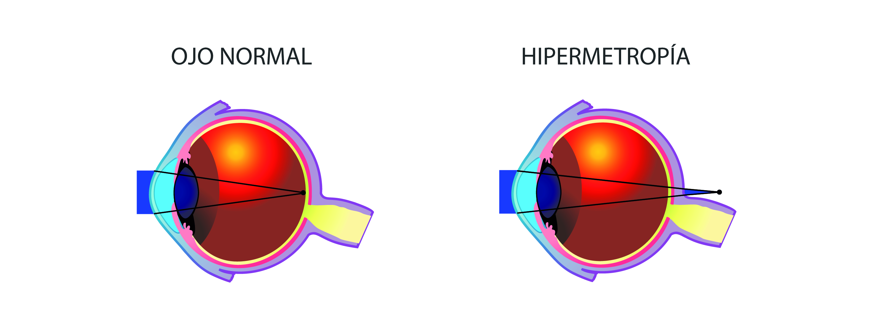 îmbunătăți vederea ochilor presopunctura pentru restabilirea vederii