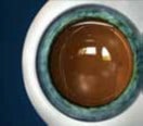 Operación lente inatrocular ICL mallorca